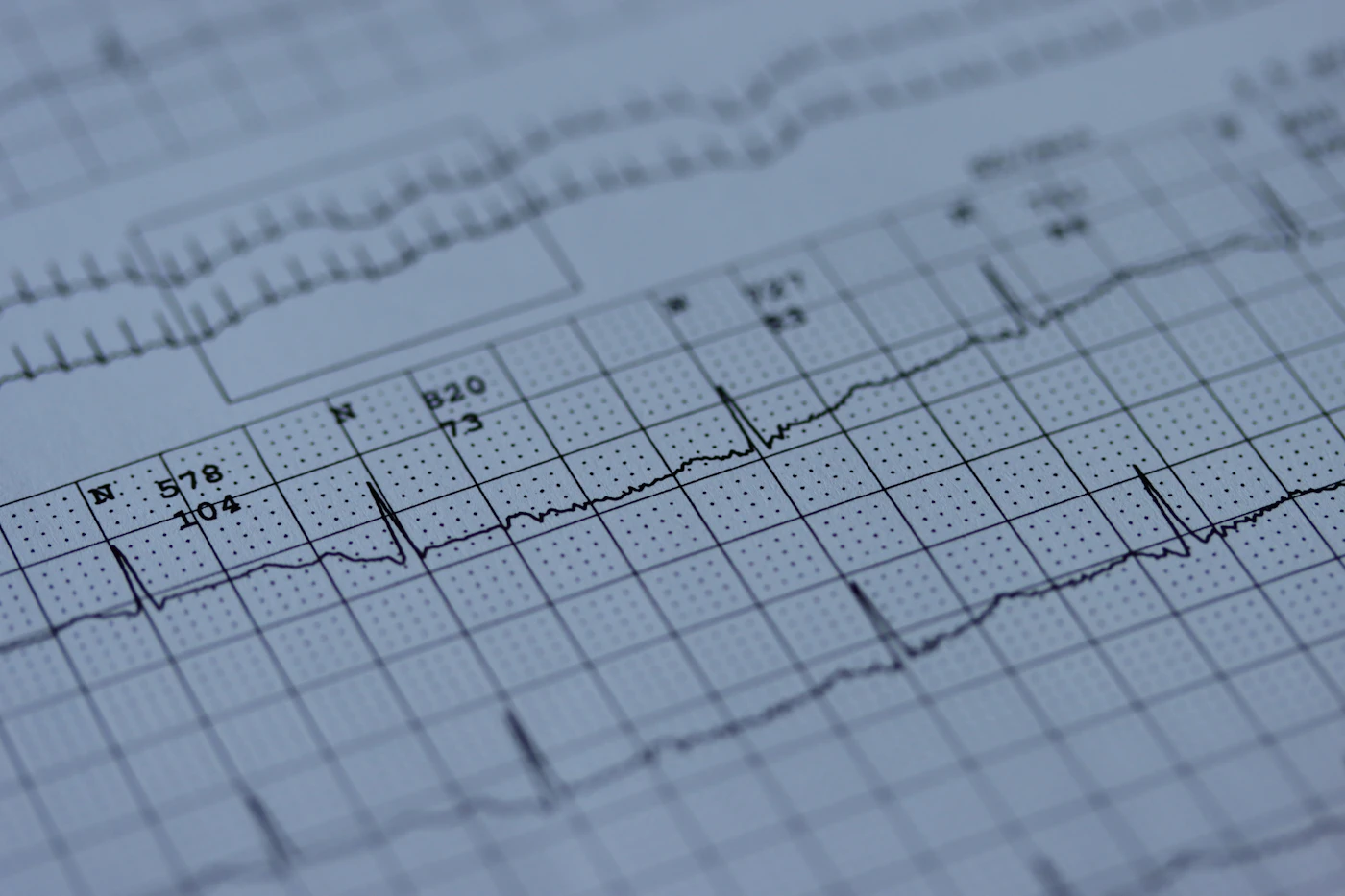 Close-up of an electrocardiogram printout showing heart rhythm tracings