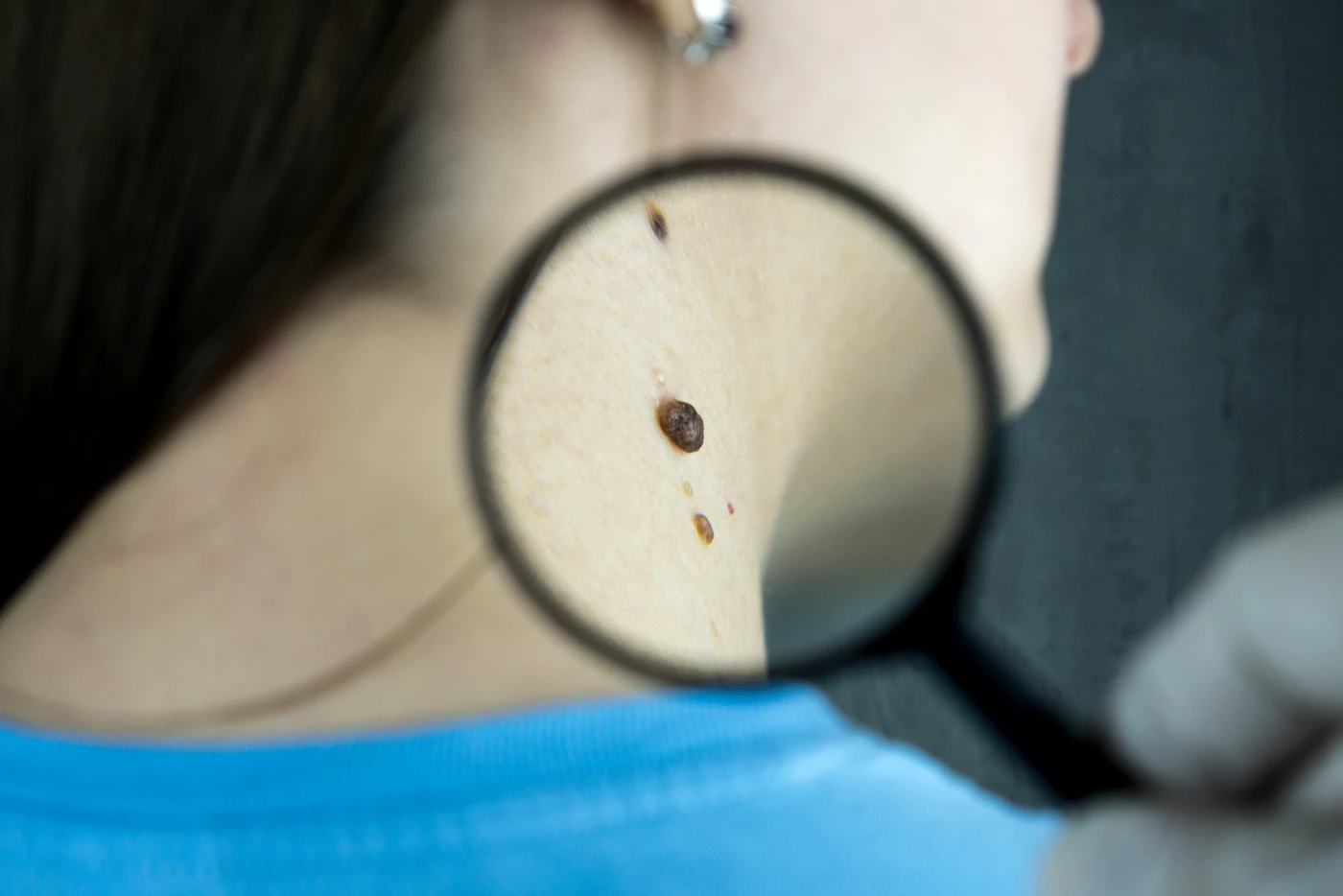 Clinician examining a mole on a patient's neck through a magnifying glass