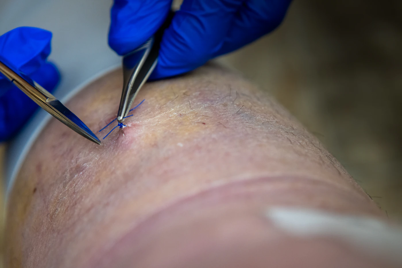 Gloved hands closing a skin incision with sutures