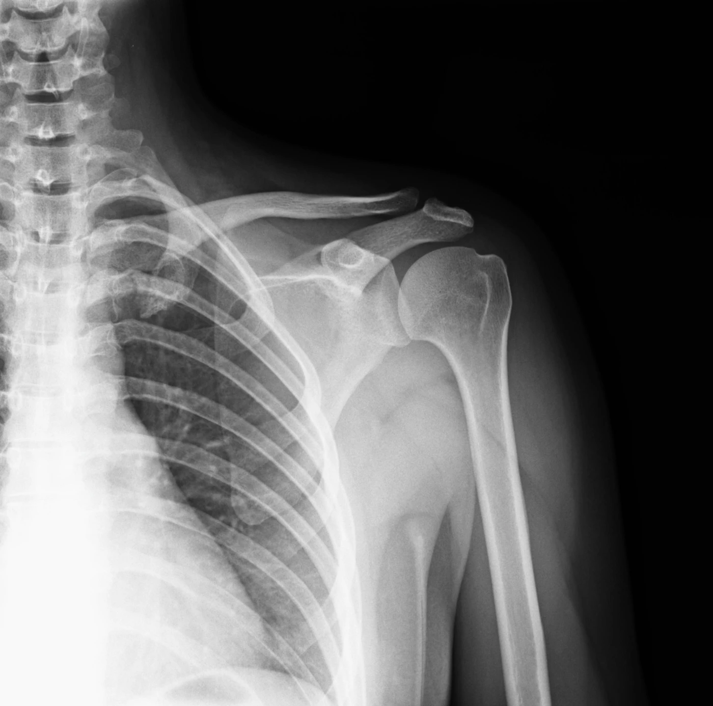 X-ray of a shoulder and upper arm