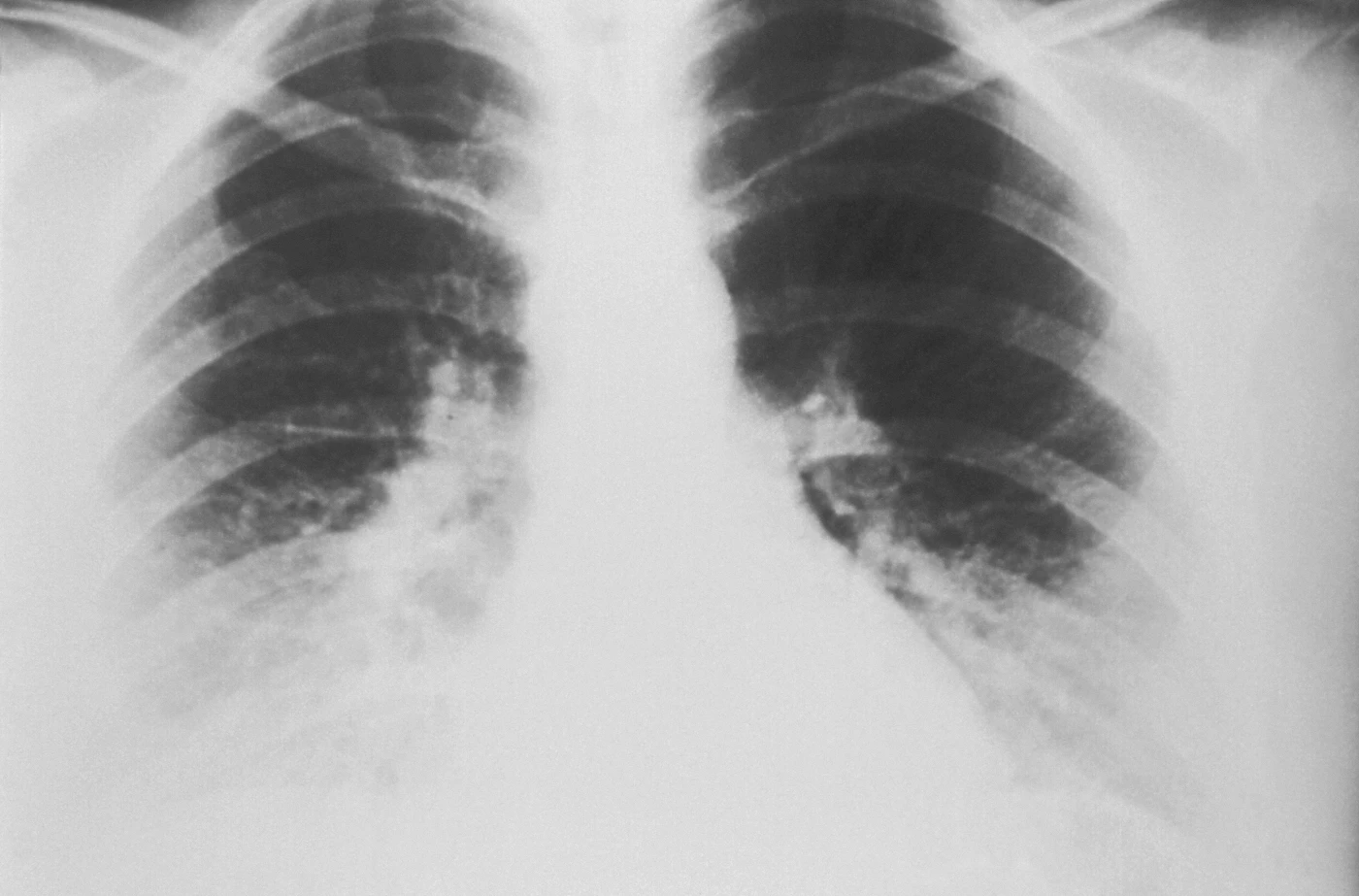 Chest X-ray showing both lungs